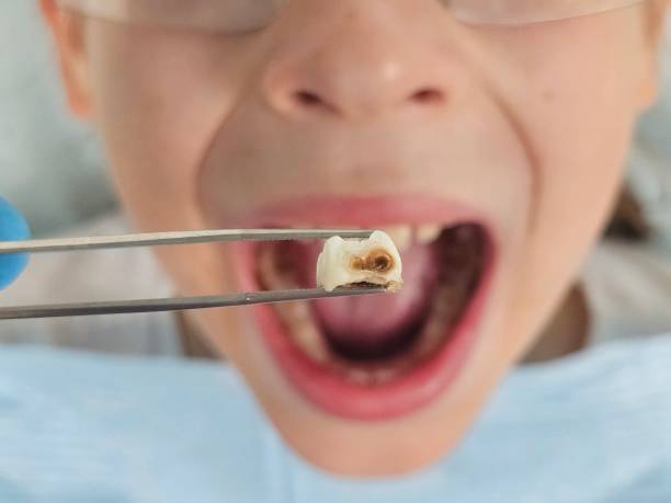 Best Broken Tooth Emergency  in Choctaw Lake, OH